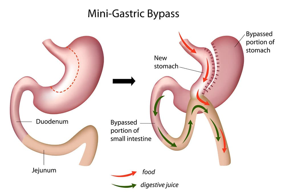 gastrik-bypass