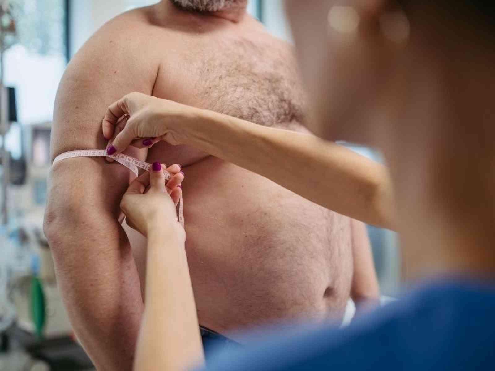 Obezite Tedavisinde Tüp Mide Ameliyatı