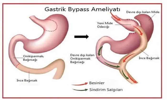 Gastrik Bypass Ameliyatı